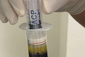 ACP Spritze zur Behandlung bereit