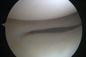 Knie mit Blick auf Knorpel und den intakten Meniskus
